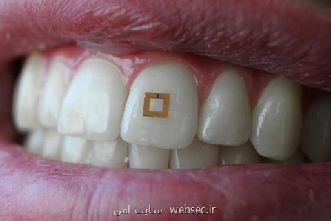 سنسور قابل نصب بر دندان عادات غذایی شما را بررسی می كند