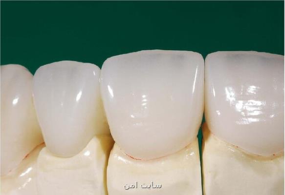 امكان ساخت دندان های سرامیكی در كشور فراهم گردید